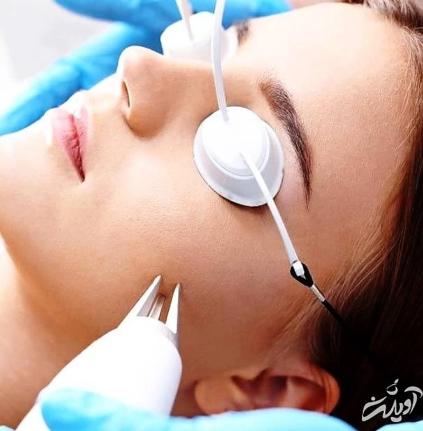 لیزر ایتریم آلومینیوم گارنت اربیوم لیزر